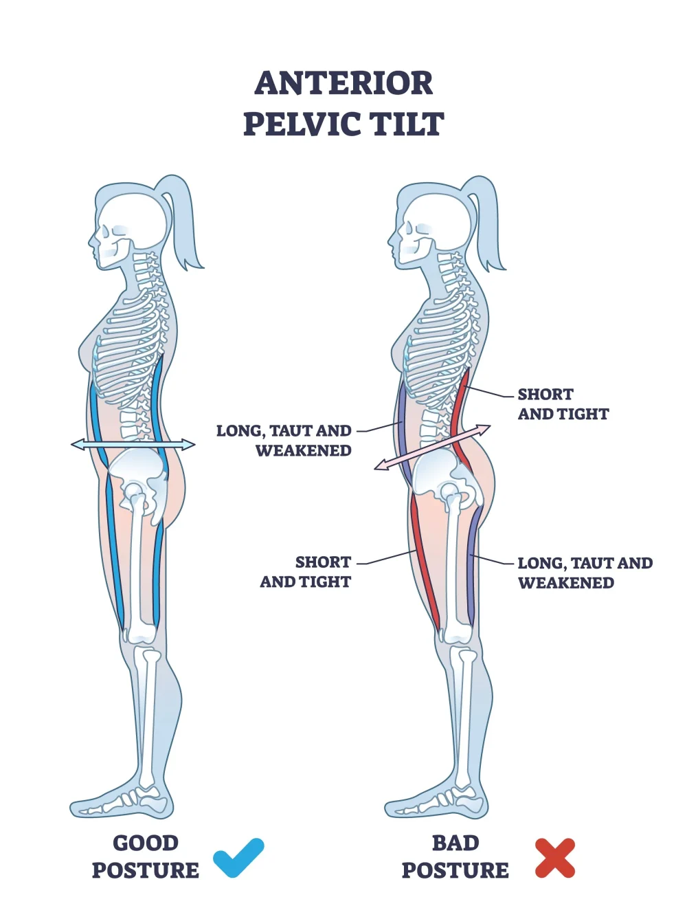 Posture Correction 3 Poor posture correction, low back pain, chiropractic care, chiropractic adjustments, spinal health, wellness chiropractor.